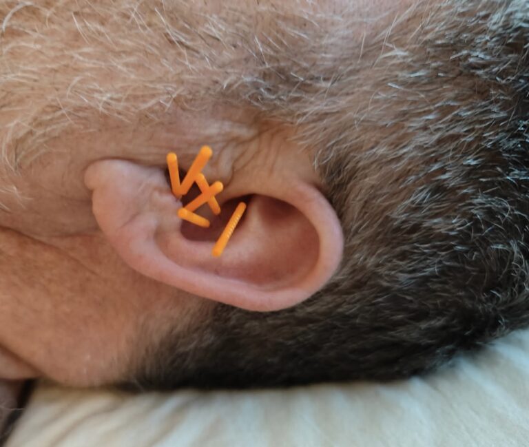 Nåle til øreakupuntur behandling