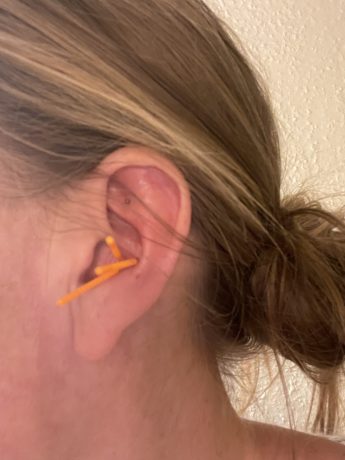 Øreakupunktur, nåle